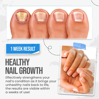 🛡️FungusShield Nail Treatment Cream